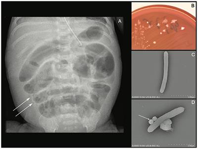 Case Report: Clostridium neonatale Bacteremia in a Preterm Neonate With Necrotizing Enterocolitis